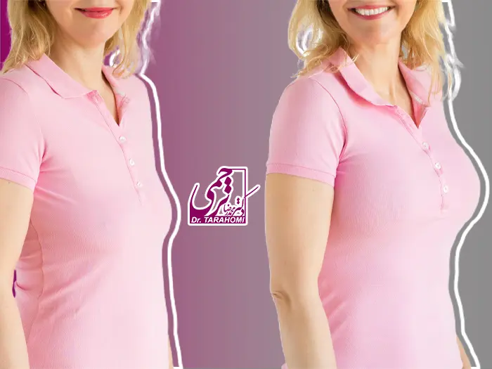 جراحی لیفت سینه