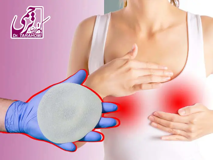 التهاب بعد از پروتز سینه