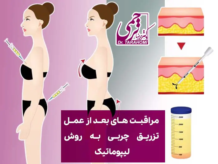 ترانسفر چربی