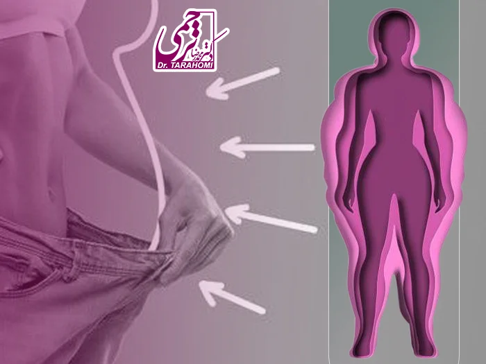 سفتی شکم بعد ابدومینوپلاستی