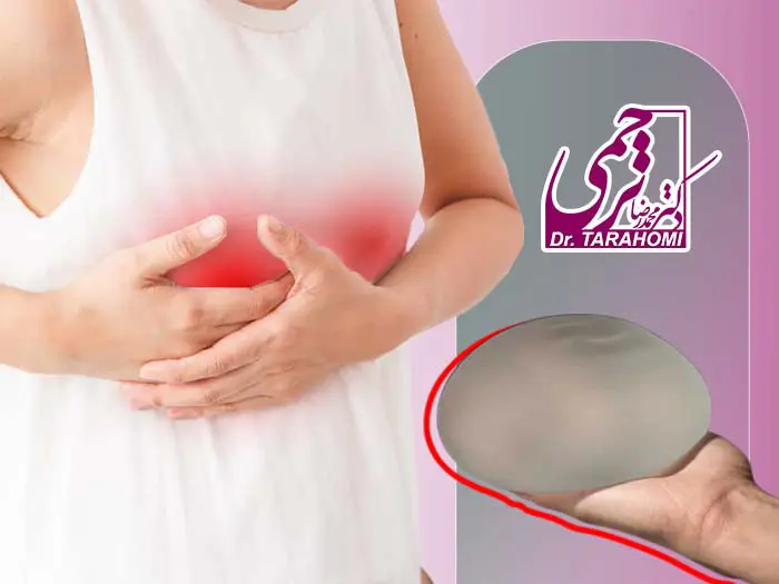 ورم بعد از پروتز سینه