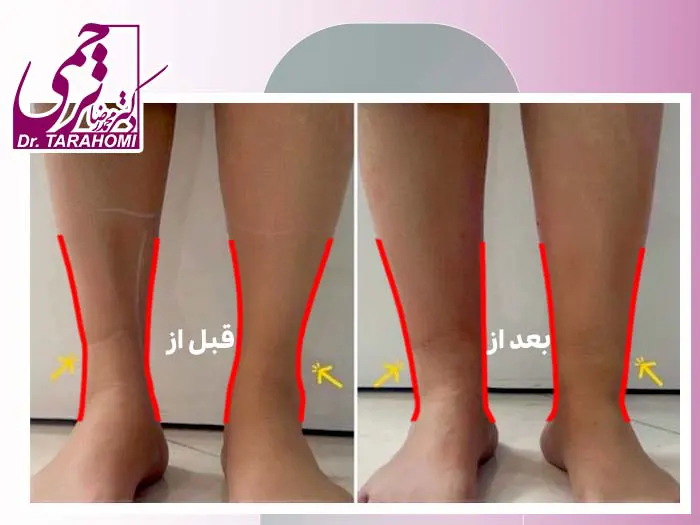 تزریق چربی به مچ پا