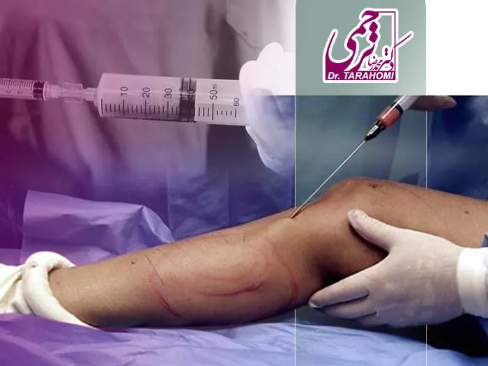 نحوه تزریق چربی به مچ پا