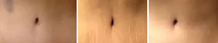 عکس ناف بعد عمل ابدومینوپلاستی