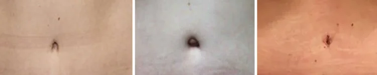 عکس ناف بعد عمل ابدو