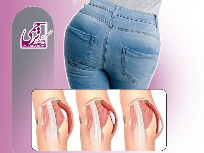 پروتز باسن