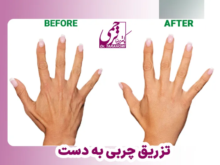 تزریق چربی به دست