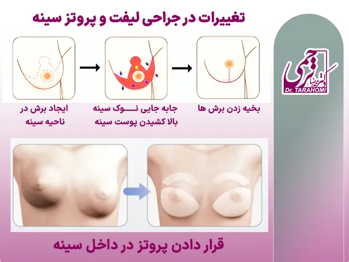 لیفت و پروتز سینه