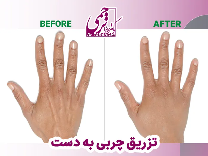 نمونه کار تزریق چربی به دست