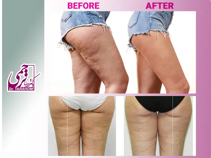 درمان سلولیت با لیپوماتیک