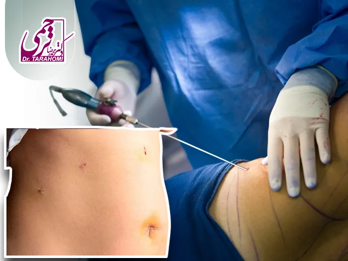 روش های کاهش ورم بعد لیپوماتیک