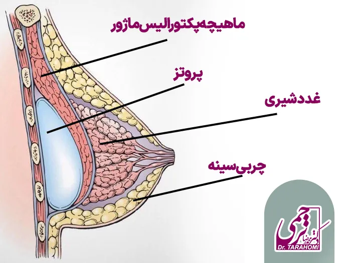 قرارگیری پروتز زیر عضله سینه