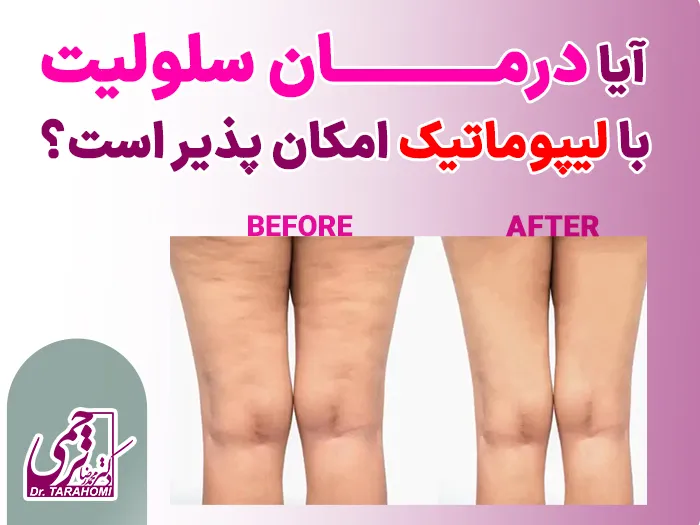 لیپوماتیک برای درمان سلولیت