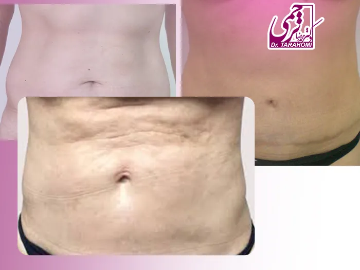 ناهمواری پوست بعد از لیپوماتیک