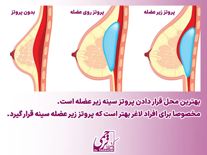 پروتز سینه زیر عضله