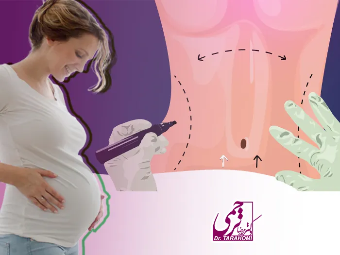 بارداری بعد جراحی زیبایی شکم