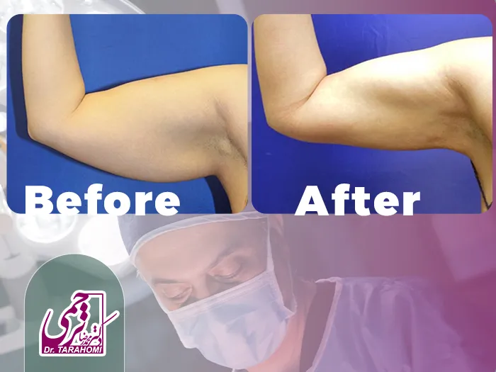 بخیه لیفت بازو