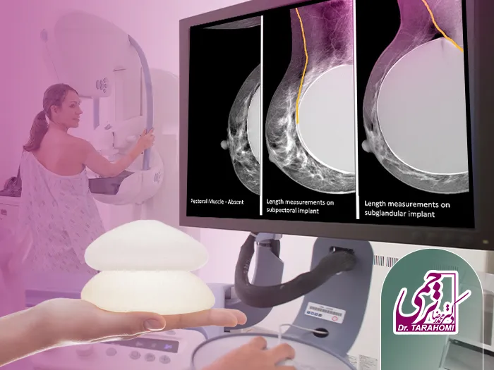 ماموگرافی بعد پروتز