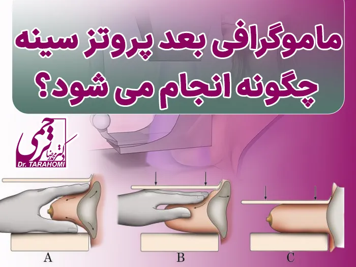 ماموگرافی بعد پروتز
