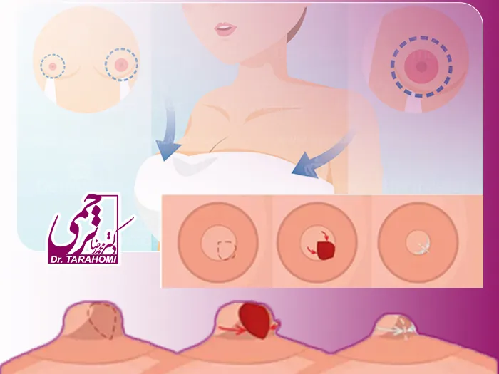 کوچک کردن نوک سینه