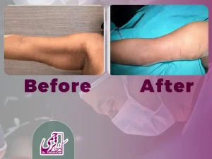 جای بخیه لیفت بازو