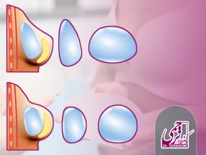 پروتز دائمی