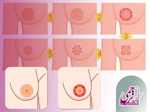 کوچک کردن نوک سینه با جراحی
