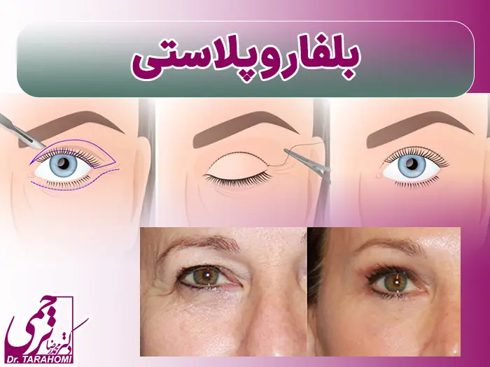 بلفاروپلاستی