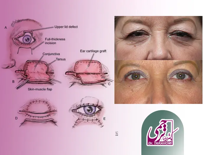 جراحی زیبایی پلک
