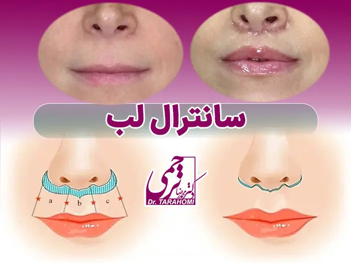 جراحی لیفت سانترال