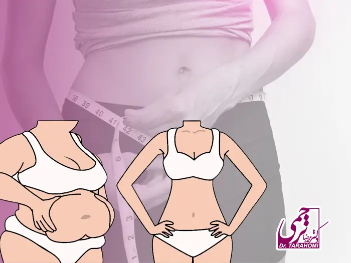 عمل لیپو ابدو همزمان