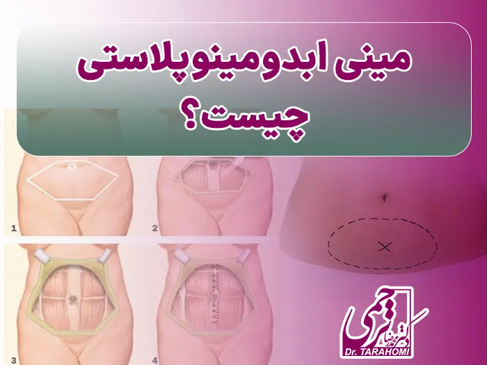 مینی ابدو