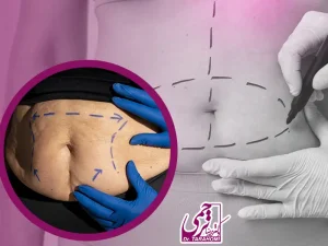 مینی ابدومینوپلاستی