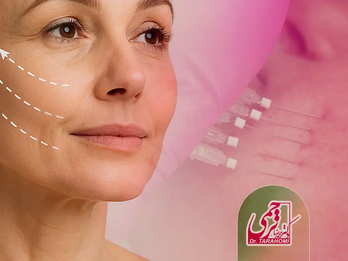 استفاده از نخ در لیفت صورت