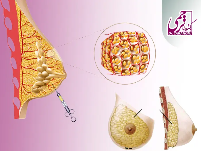 تزریق چربی به سینه