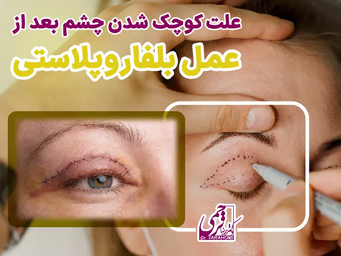 علت کوچک شدن چشم بعد بلفاروپلاستی