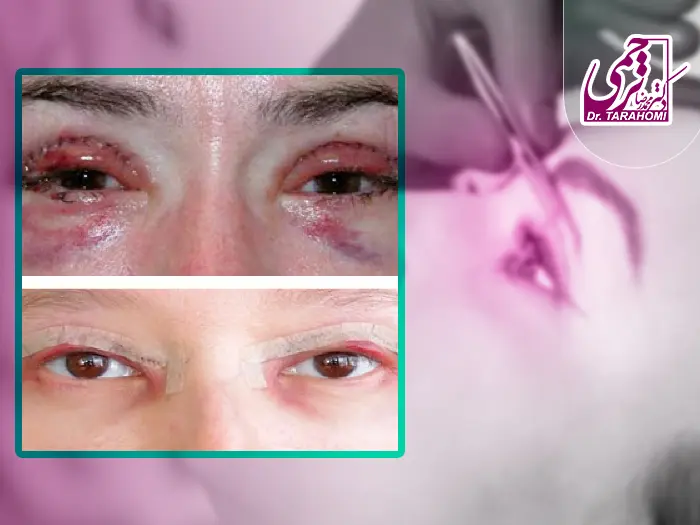 عوارض بلفاروپلاستی