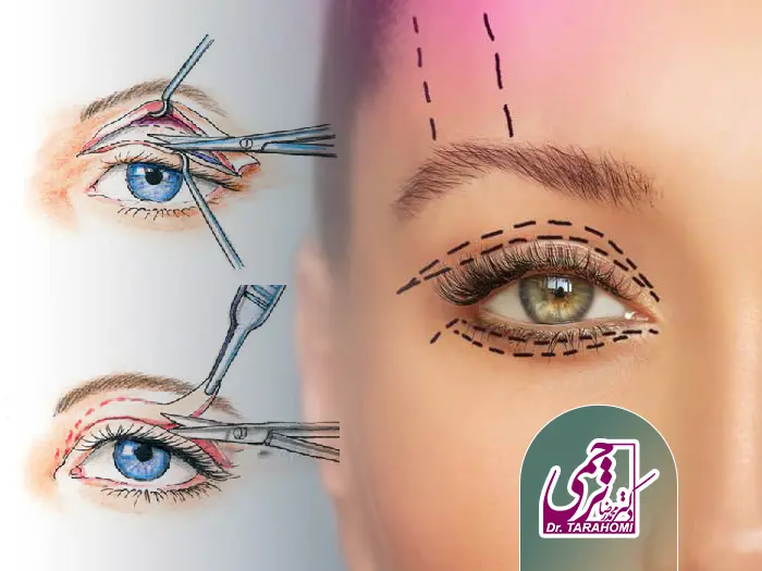 کوچک شدن چشم بعد بلفاروپلاستی