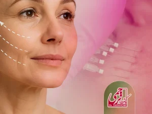 استفاده از نخ در لیفت صورت