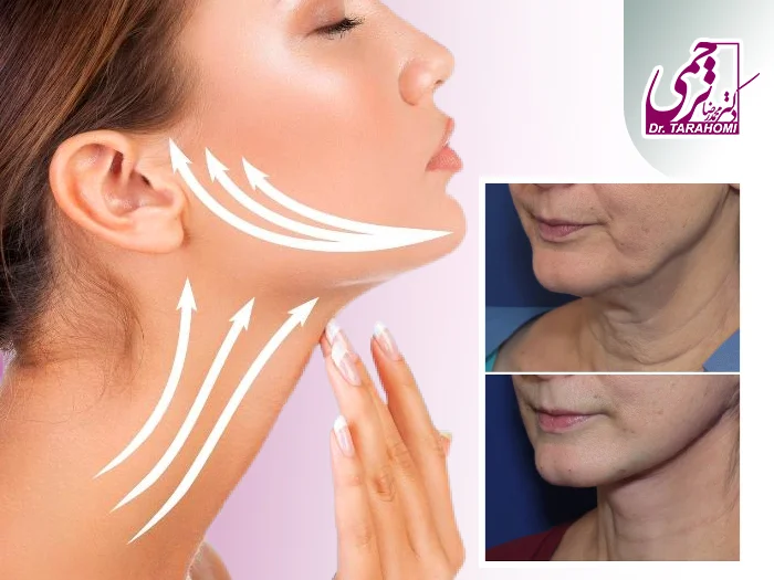 تاثیر لیفت گردن