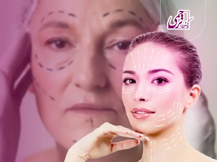 خطرات لیفت صورت