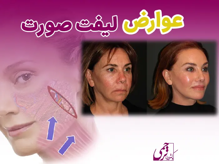 عوارض لیفت صورت