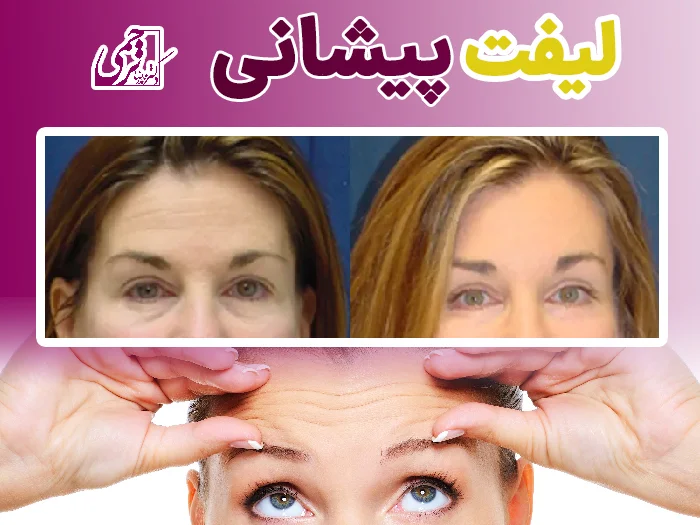 لیفت پیشانی