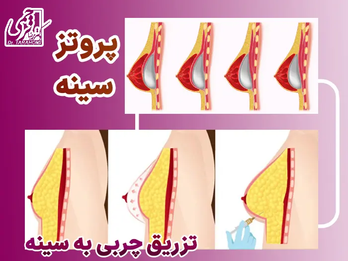 مقایسه پروتز و تزریق چربی