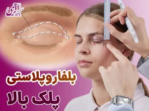 بلفاروپلاستی پلک بالا