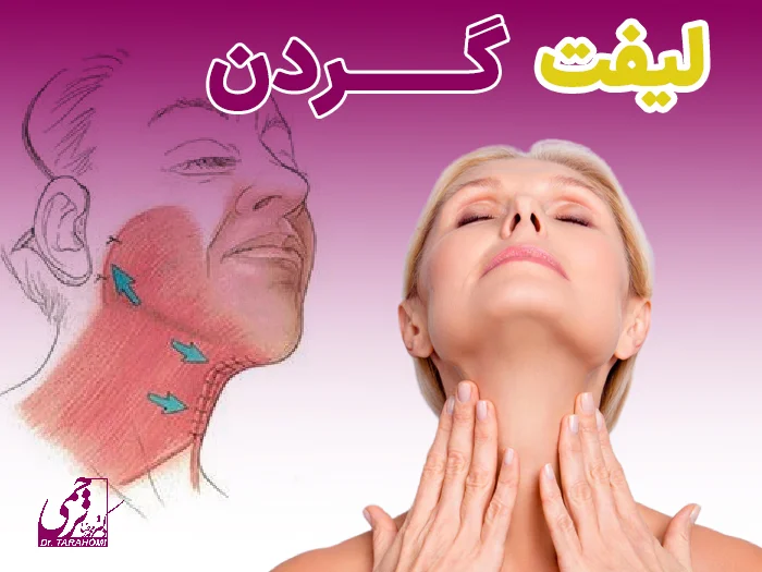 لیفت گردن