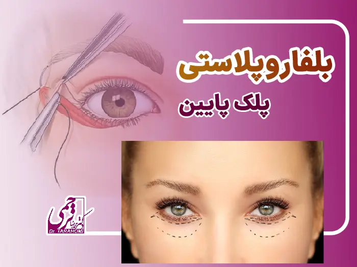 بلفاروپلاستی پلک پایین
