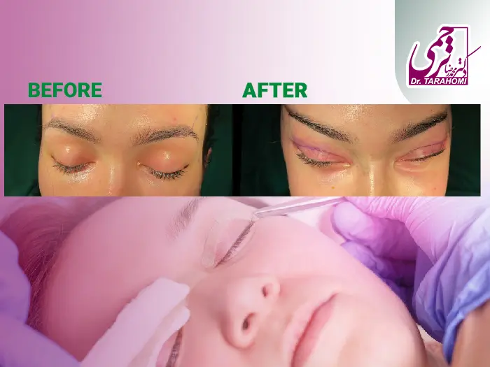 بلفاروپلاستی چشم گربه ای