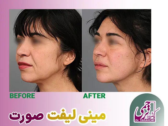 مینی لیفت صورت