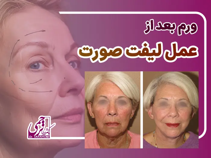 ورم بعد لیفت صورت